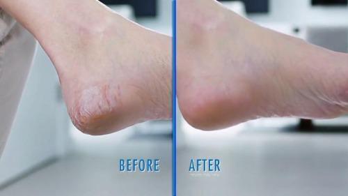 Electric Callus Remover - Built-In Vacuum Rechargeable Motorized Feet Foot Pedicure Tool Exfoliation Dead Skin - 5econds.co